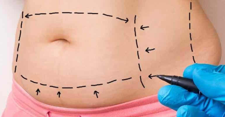 Liposuction tuzla