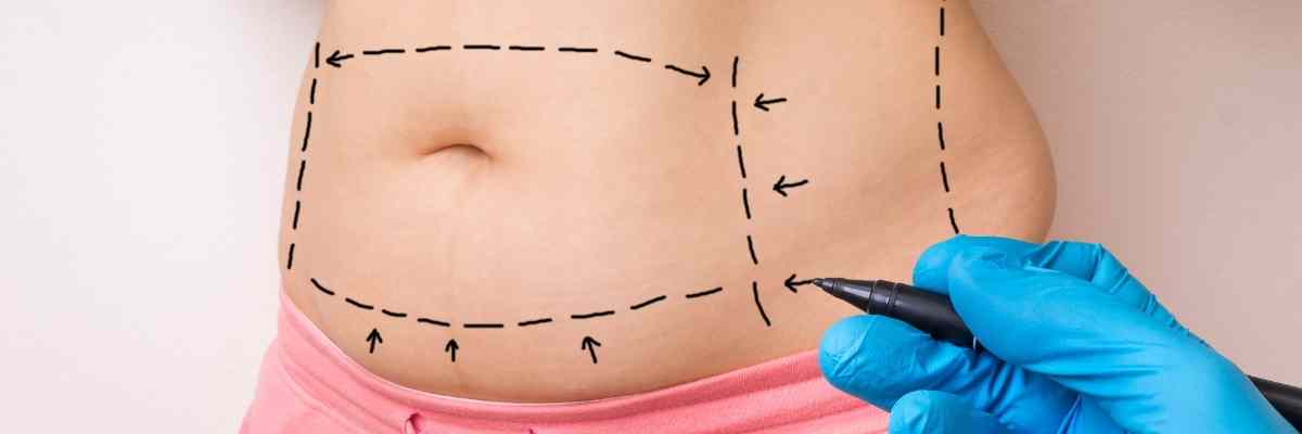 Liposuction tuzla